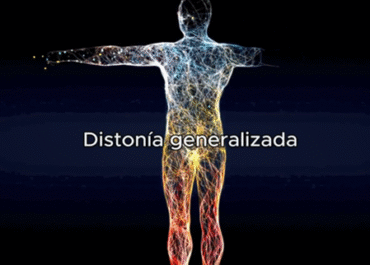 Decimo tercera entre de la campaña "Aprendemos sobre distonía". Distonía generalizada